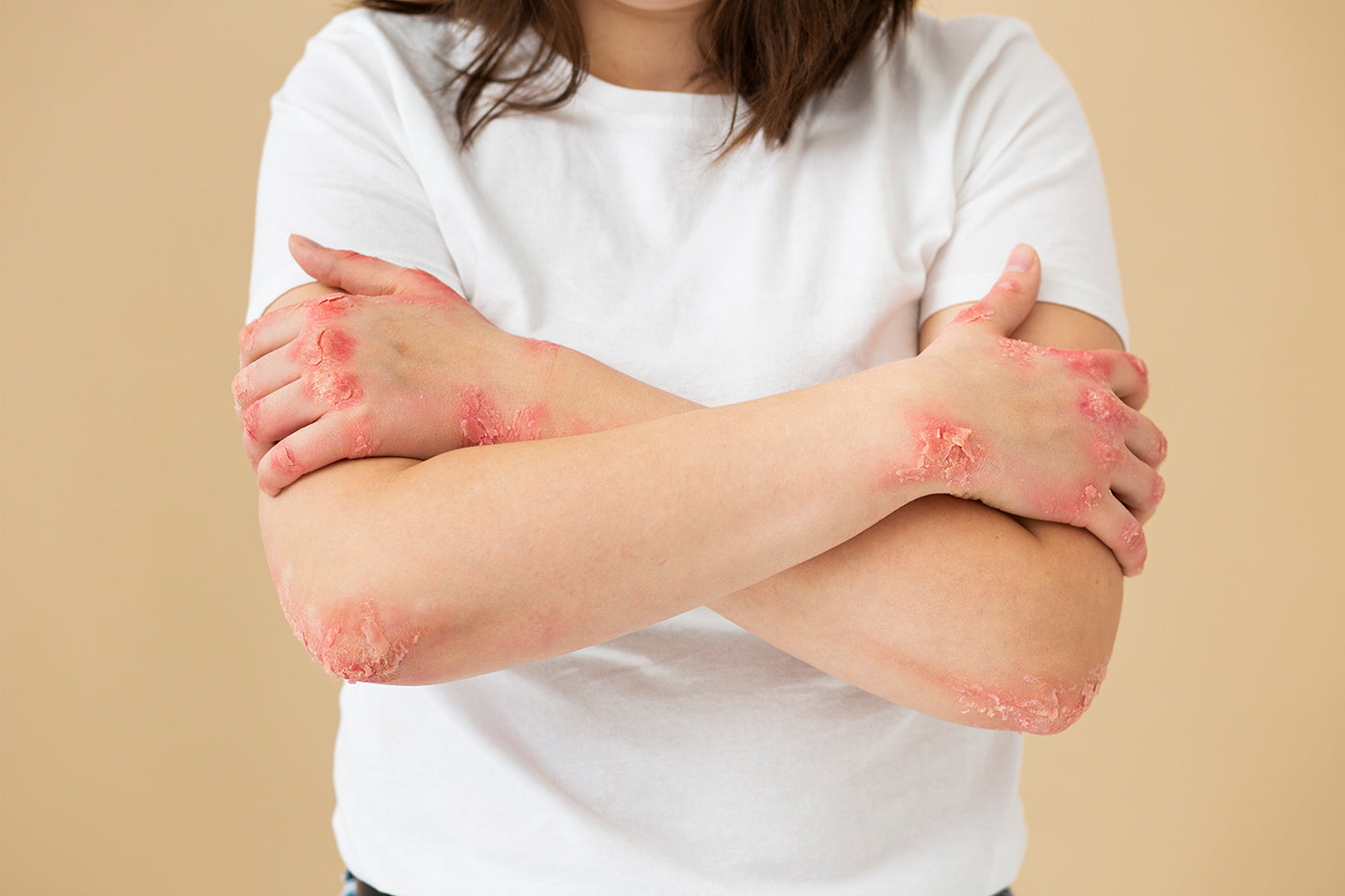 Integrating the Oloproteic Diet into Psoriasis Management: A Promising Therapeutic Strategy